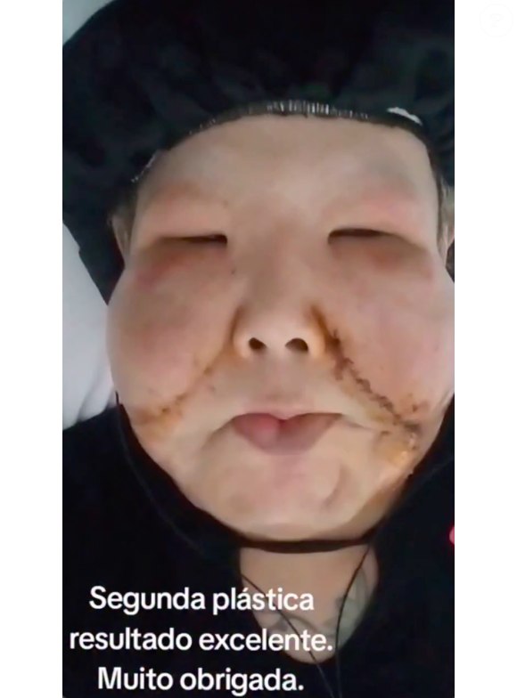 "Esse foi o resultado maravilhoso. Deixou exatamente o meu rosto do jeito que eu queria. Retirou muita papada, e bochecha, que era maior, agora está menor que a outra de tanto que tirou", comemorou Juju do Pix