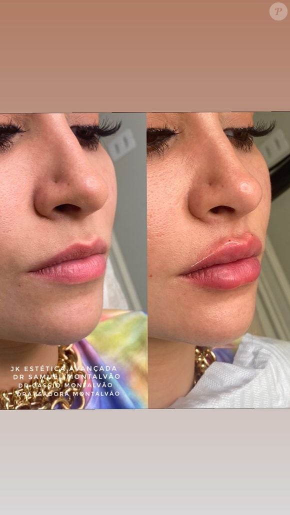Bianca Andrade fez rinomodelação: 'Nariz arrebitadinho'