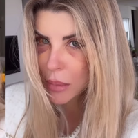 O que aconteceu com Iris Stefanelli? ex-BBB surge com olho roxo, gera preocupação e esclarece causa do hematoma