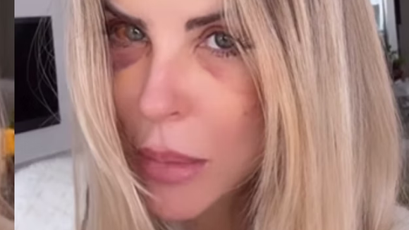 O que aconteceu com Iris Stefanelli? ex-BBB surge com olho roxo, gera preocupação e esclarece causa do hematoma