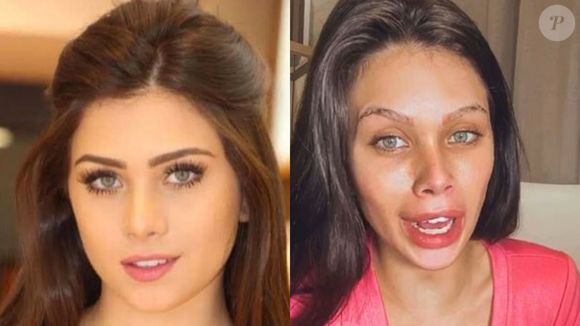 Antes e depois de Flávia Pavanelli: influenciadora foi massacrada por ter abusado dos procedimentos estéticos e os reverteu