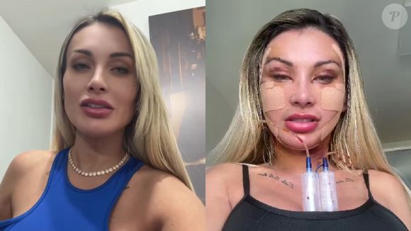 Antes e depois de Andressa Urach: influenciadora está assim após cirurgia no rosto, mas irá desinchar nas próximas semanas