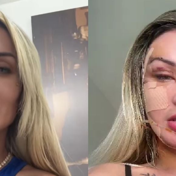 Antes e depois de Andressa Urach: influenciadora está assim após cirurgia no rosto, mas irá desinchar nas próximas semanas