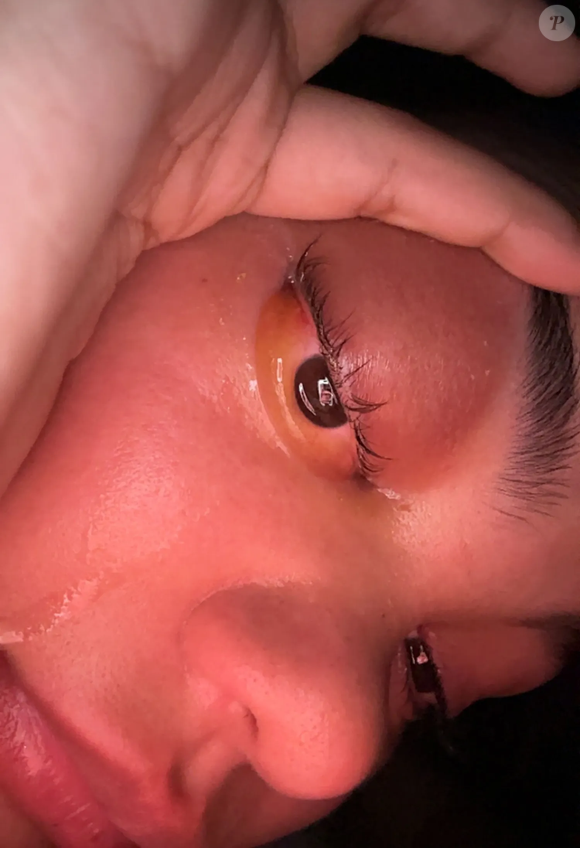 Bell explicou que estava esfregando o olho por causa do incômodo e que, ao acordar no dia 29 de outubro, percebeu algo alarmante: “meu olho tinha saltado para fora, como uma bola de golfe. Meu olho estava enorme”.