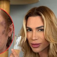 Quem era Junior Dutra? Influenciador que morreu após procedimento estético queridinho das famosas denunciou dentista por fraude: 'Veia estourada'