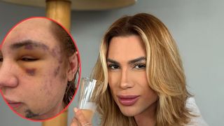 Quem era Junior Dutra? Influenciador que morreu após procedimento estético queridinho das famosas denunciou dentista por fraude: 'Veia estourada'