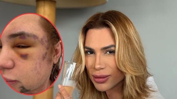 Quem era Junior Dutra? Influenciador que morreu após procedimento estético queridinho das famosas denunciou dentista por fraude: 'Veia estourada'