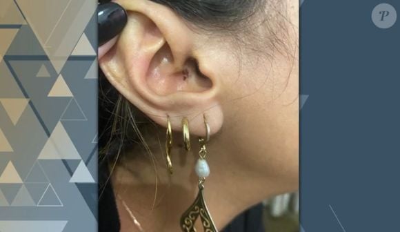 A ex-namorda de Cartolouco mostrou a foto da queimadura em sua orelha