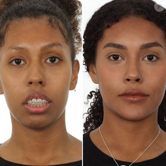Dra. Katyuscia compartilhou o antes e depois da irmã de Gracyanne Barbosa