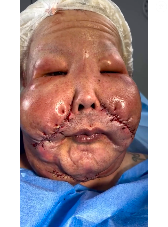 Juju do Pix passou por uma cirurgia de remoção do óleo mineral de seu rosto no dia 20 de novembro de 2025