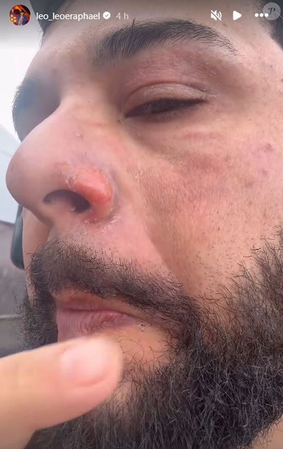 Léo mostrou as queimaduras em seu rosto