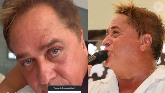 Antes e depois: Leonardo fez blefaroplastia