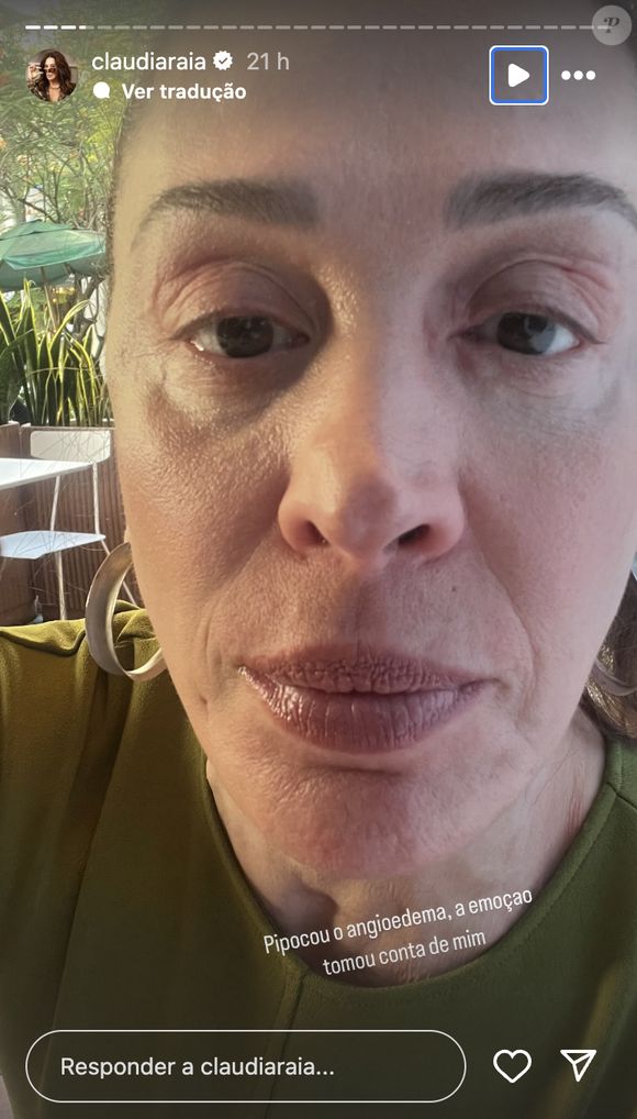 Claudia Raia mostrou rosto inchado aos seguidores por conta de angioedema no ano de 2025