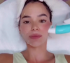 Bruna Marquezine é adepta do bioestimulador de colágeno em seu rosto e corpo para ficar com a pele lisinha
