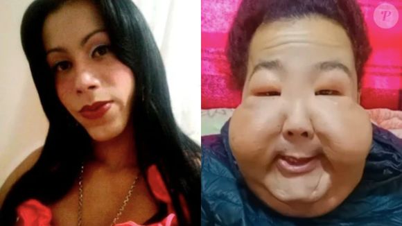 Juju do Pix antes e depois: influenciadora mudou drasticamente após injetar óleo mineral no rosto