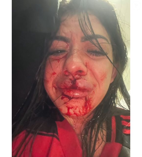 Namorada do cantor Dieguin Damasceno vai precisar de cirurgia após ser agredida e ter três dentes quebrados