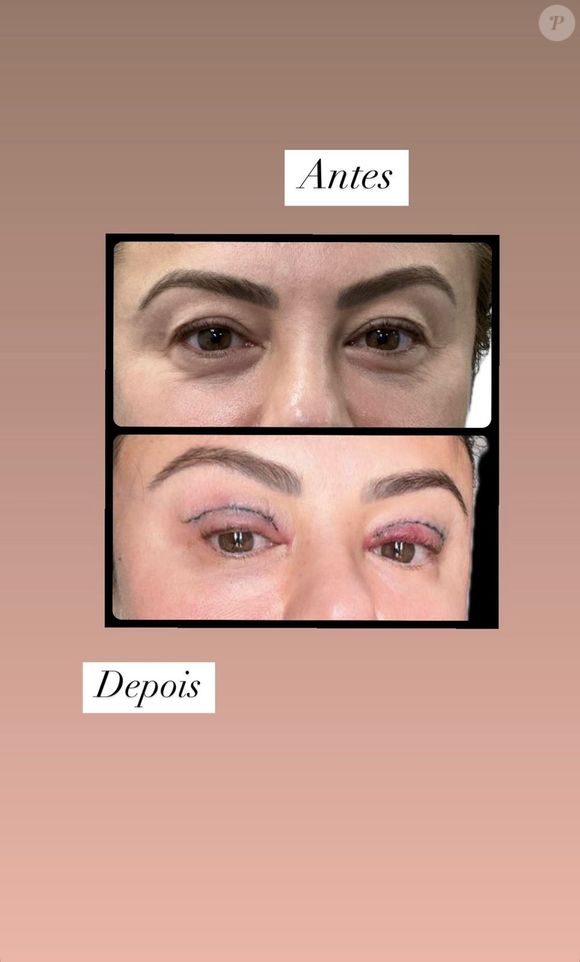 Antes e depois de Poliana Rocha com blefaroplastia foi postado pela influenciadora na web