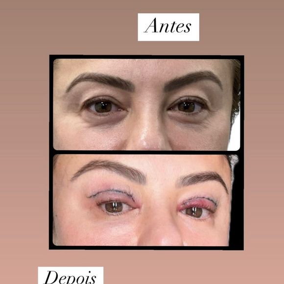 Antes e depois de Poliana Rocha com blefaroplastia foi postado pela influenciadora na web