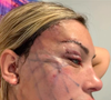Já sem curativos, mas com a pele ainda marcada e com pontos, Andressa Urach impressionou ao já aparecer 'toda esticada'