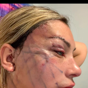 Já sem curativos, mas com a pele ainda marcada e com pontos, Andressa Urach impressionou ao já aparecer 'toda esticada'