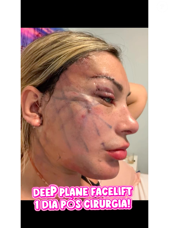 Já sem curativos, mas com a pele ainda marcada e com pontos, Andressa Urach impressionou ao já aparecer 'toda esticada'