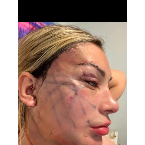 Já sem curativos, mas com a pele ainda marcada e com pontos, Andressa Urach impressionou ao já aparecer 'toda esticada'