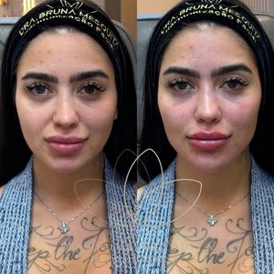 MC Mirella realizou uma harmonização facial que 'levantou' seu rosto