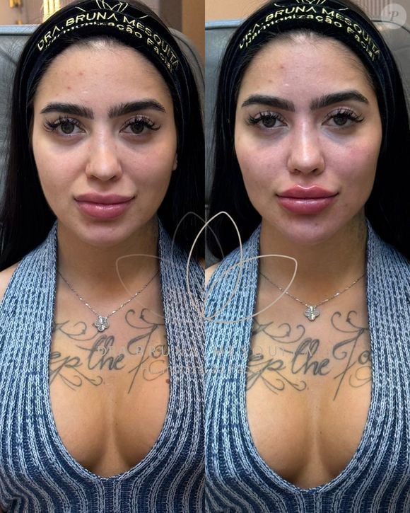 MC Mirella realizou uma harmonização facial que 'levantou' seu rosto