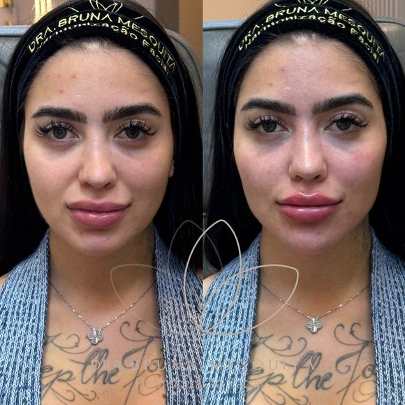 MC Mirella realizou uma harmonização facial que 'levantou' seu rosto