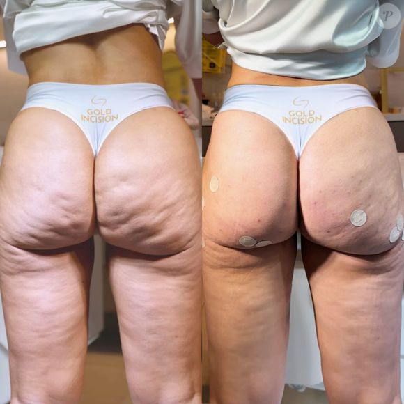 Antes e depois do bumbum de Giselle Prattes deixou até mesmo a atriz impressionada