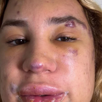 Influenciador Junior Dutra morre após complicações de procedimento estético 'fox eyes', tendência estética que promete levantar o olhar