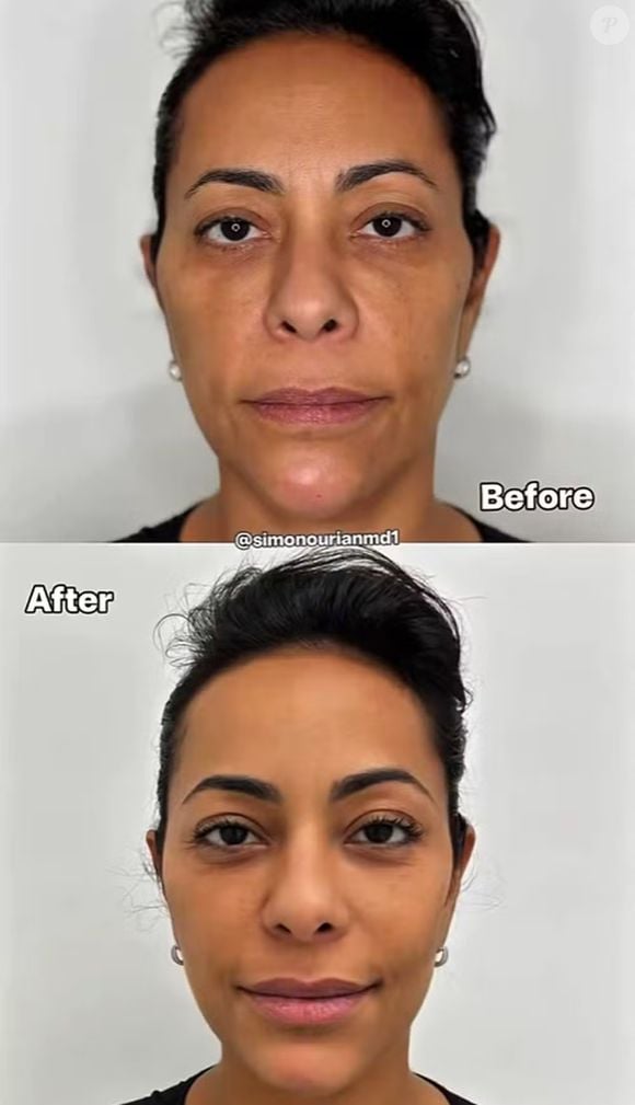 Samantha Schmütz apareceu muito mais jovem no 'antes e depois' publicado pelo médico de Kim Kardashian