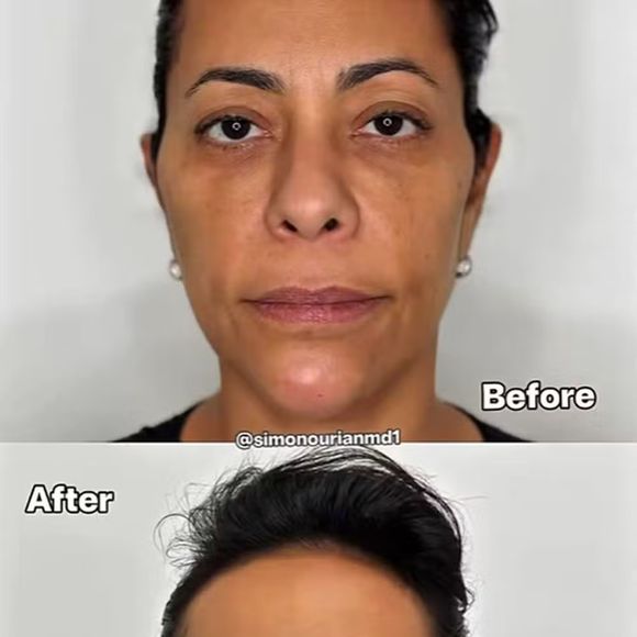 Samantha Schmütz apareceu muito mais jovem no 'antes e depois' publicado pelo médico de Kim Kardashian