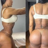 Gracyanne Barbosa ganha 20 kg em apenas três dias e choca a web; musa fitness explica mudança brusca na balança após cirurgia
