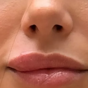 A celulite facial, que acometeu Bruna Biancardi, é uma infecção com potencial grave, explica a Dra. Fernanda Nichelle, médica especialista em estética