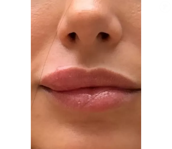 A celulite facial, que acometeu Bruna Biancardi, é uma infecção com potencial grave, explica a Dra. Fernanda Nichelle, médica especialista em estética