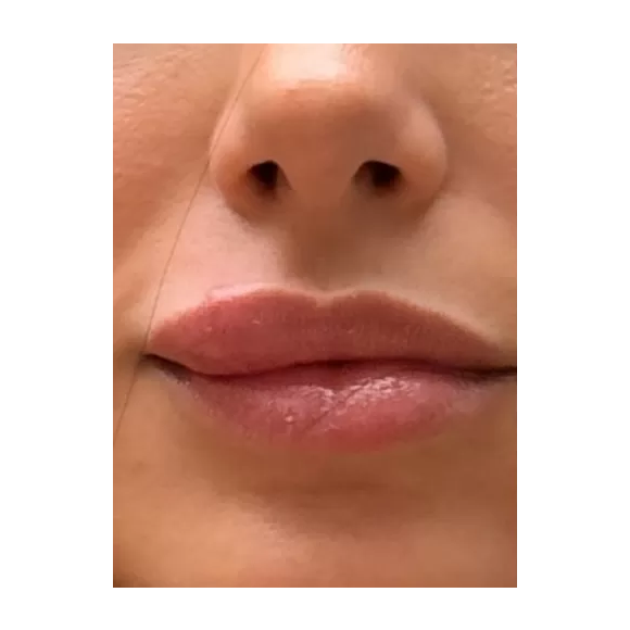 A celulite facial, que acometeu Bruna Biancardi, é uma infecção com potencial grave, explica a Dra. Fernanda Nichelle, médica especialista em estética