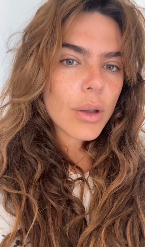 Mariana Goldfarb explica que seu melasma emocional resvala no hormonal, aparecendo de forma mais forte na pele