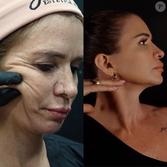 "A cicatriz é imperceptível, nem meu maquiador consegue encontrar", disse Viviane Tube em um vídeo