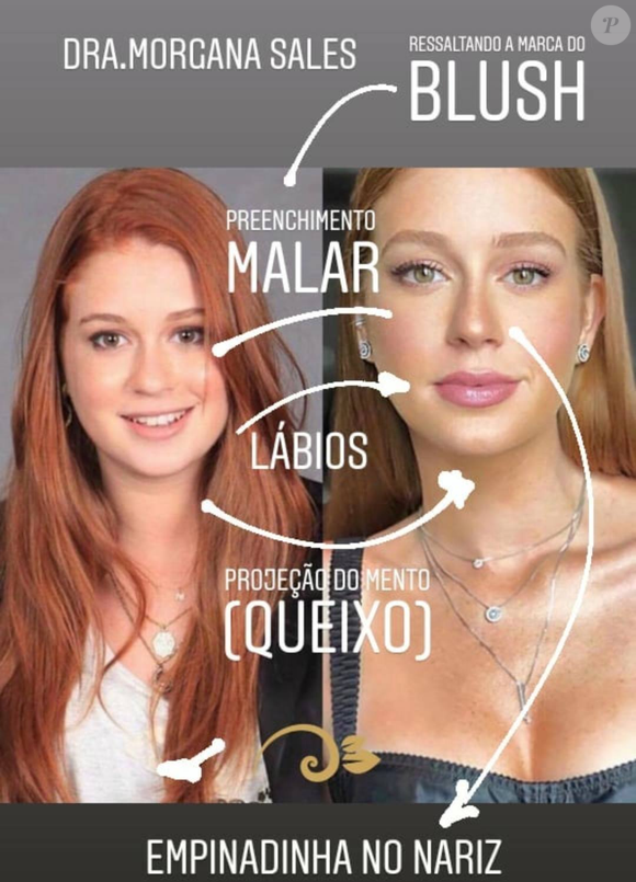 Especialista lista mudanças no rosto de Marina Ruy Barbosa