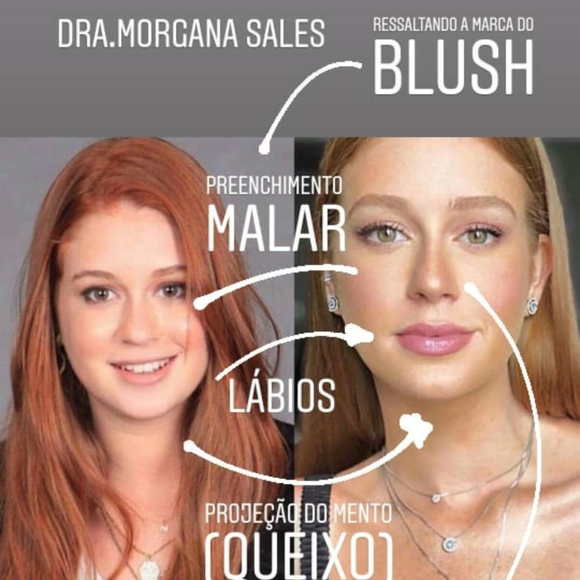 Especialista lista mudanças no rosto de Marina Ruy Barbosa