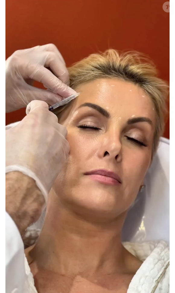 Ana Hickmann apostou no Xerf, uma nova tecnologia que estimula a produção e reorganização de colágeno para melhorar a firmeza da pele