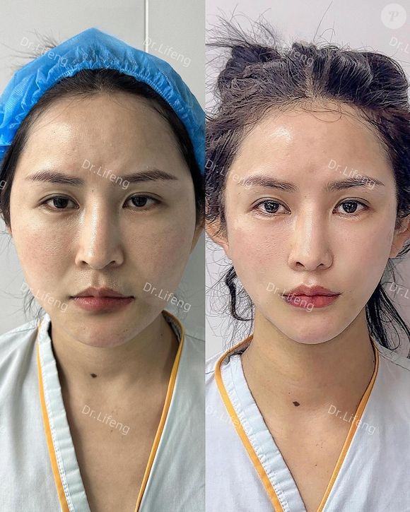 Dr. Lifeng também afina os rostos das pacientes, dando mais contorno