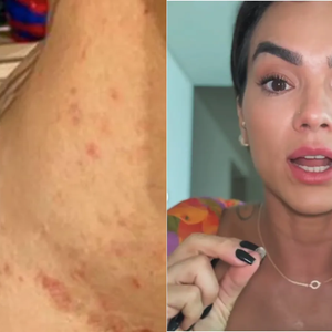 Doença sem cura e inflamatória que afeta Kelly Key pode piorar com estresse e mudança de estação; médica explica