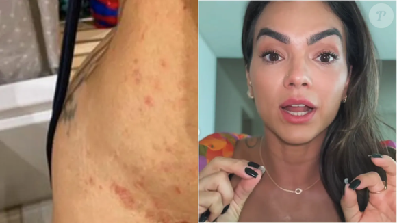 Doença sem cura e inflamatória que afeta Kelly Key pode piorar com estresse e mudança de estação; médica explica