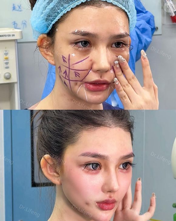 Dr. Lifeng mostra marcações no rosto de pacientes que fazem as cirurgias