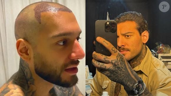 Lucas Lucco foi um dos primeiros famosos brasileiros a viralizar com o transplante capilar, feito há alguns anos