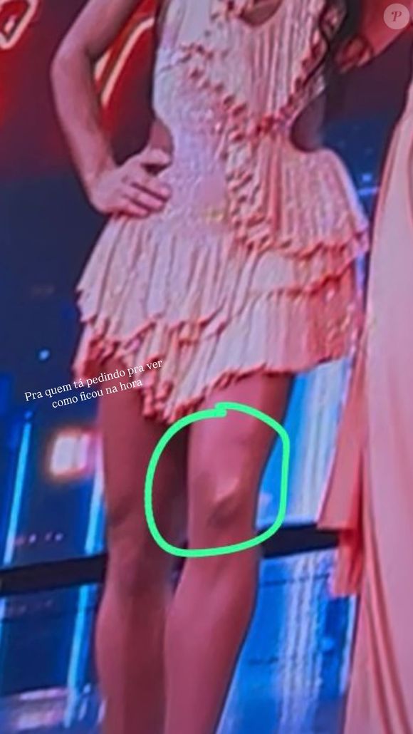 Gracyanne Barbosa mostrou como o joelho ficou logo após se machucar no 'Dança dos Famosos'. Uso constante do salto alto pode provocar dores, causar artrose e levar à cirurgia