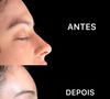 Primeiro passo de Zé Longuinho foi uma cirurgia de feminilização facial no gogó, queixo, mandíbula, nariz e a testa