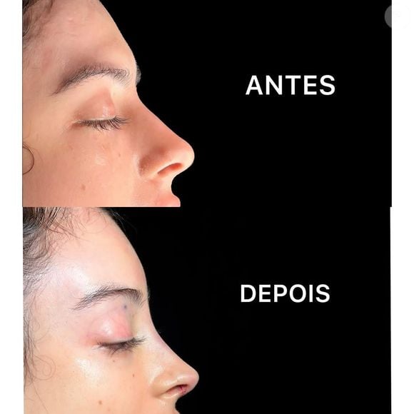 Primeiro passo de Zé Longuinho foi uma cirurgia de feminilização facial no gogó, queixo, mandíbula, nariz e a testa